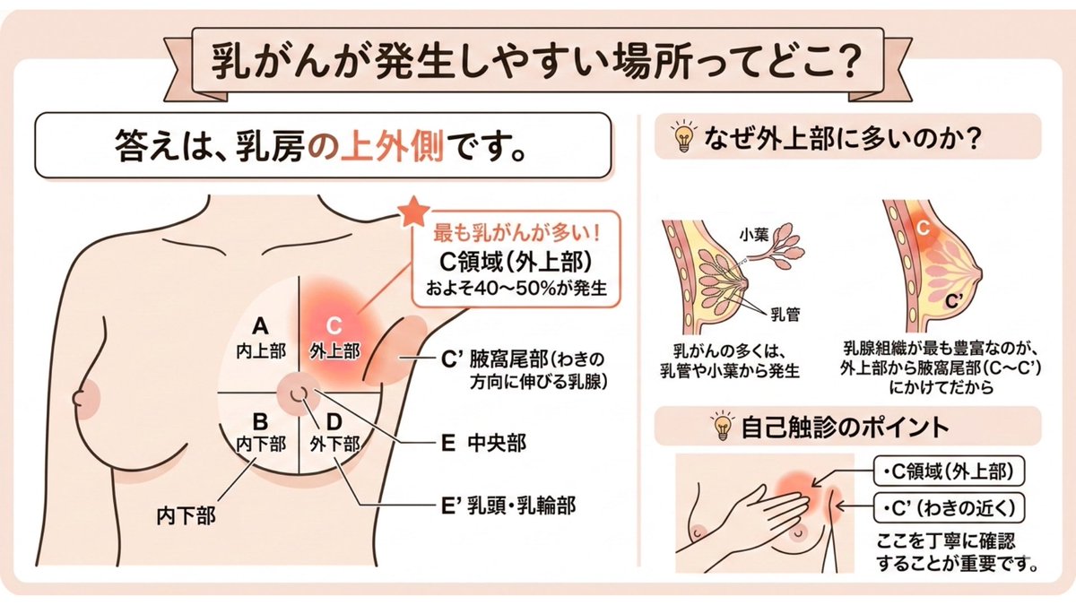 【#乳がん1分知識】#84

『乳がんが発生しやすい場所ってどこ？』

答えは、
乳房の上外側です。

日本では慣習的に、乳房を4分割にして、
中央部を含めてA〜Eのエリアで表してきました。

A：内上部
B：内下部
C：外上部
D：外下部
C’：腋窩尾部（わきの方向に伸びる乳腺）
E：中央部