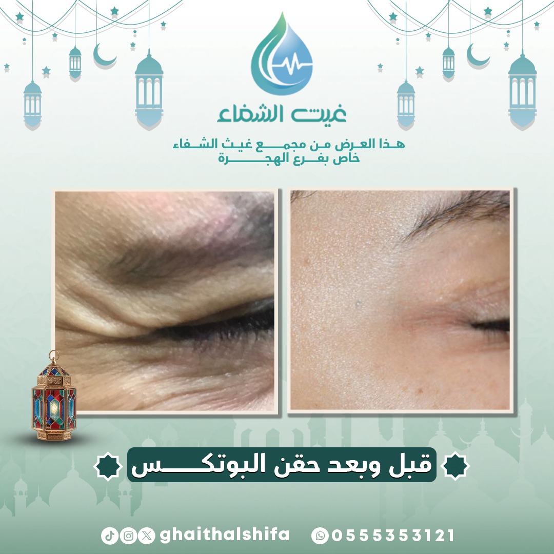 تجاعيد حول العين تعطيك شكل مرهق؟ 😔
حلّها بسيط مع حقن البوتكس ✨
نضارة، نعومة، ولمسة شباب ترجع لملامحك بكل نعومة 💉💚
#غيث_الشفاء #السعودية #المدينة_المنورة #طب #تجميل
