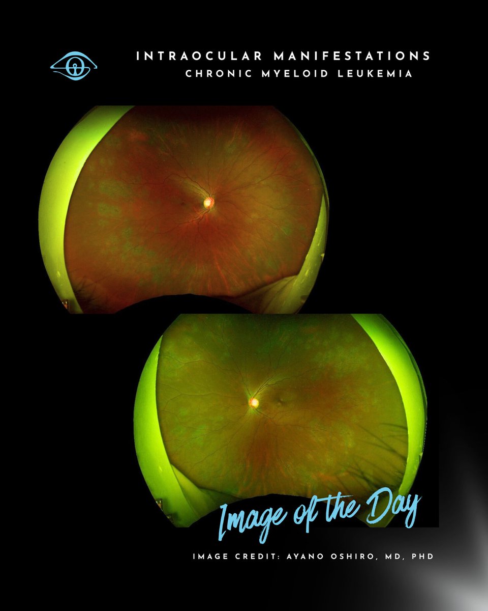 IOIS - International Ocular Inflammation Society tweet media