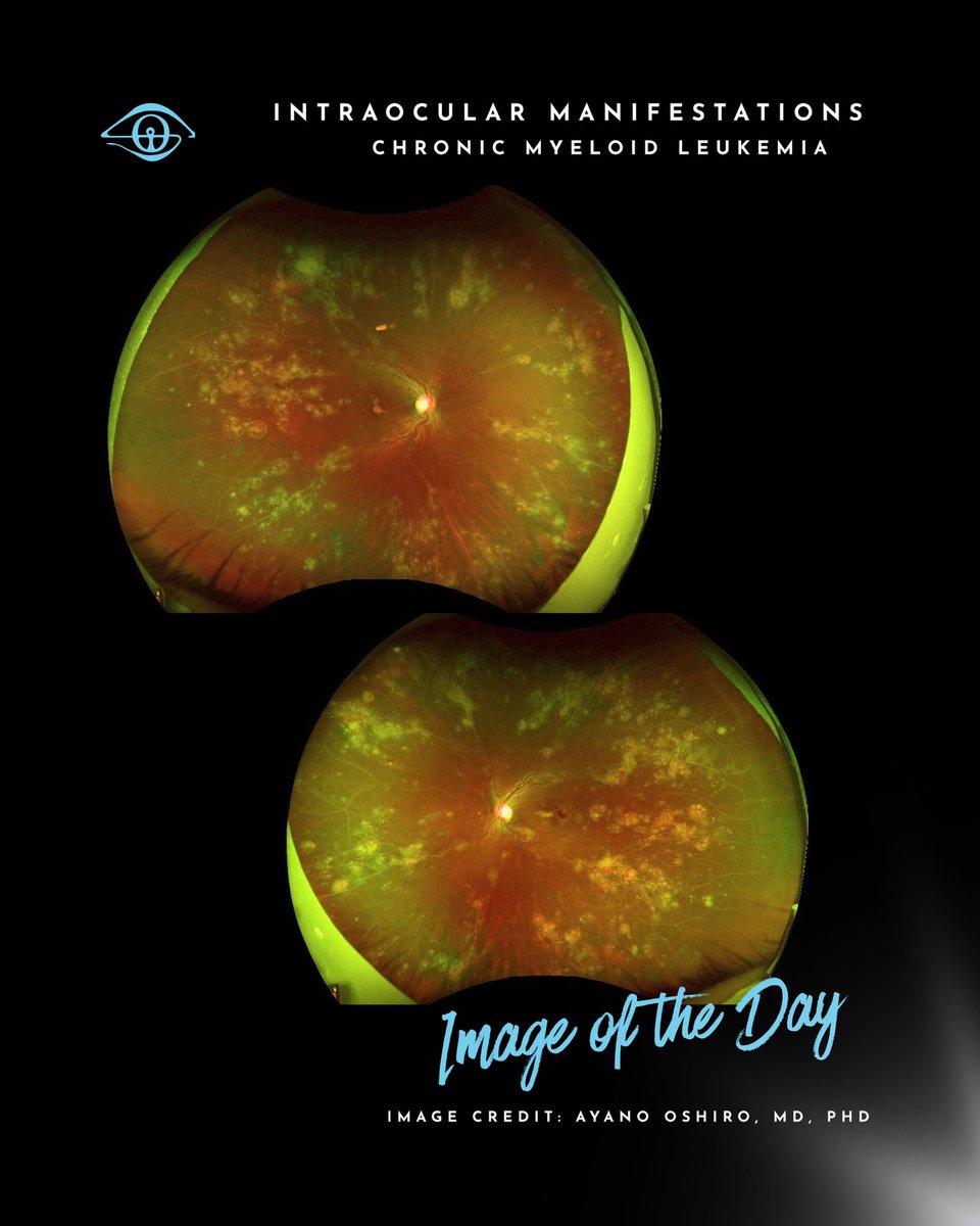 IOIS - International Ocular Inflammation Society tweet media