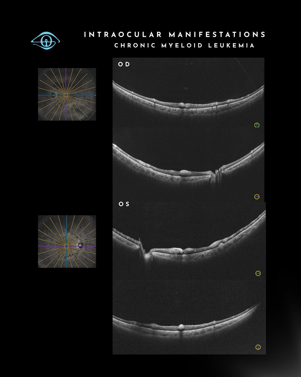 IOIS - International Ocular Inflammation Society tweet media