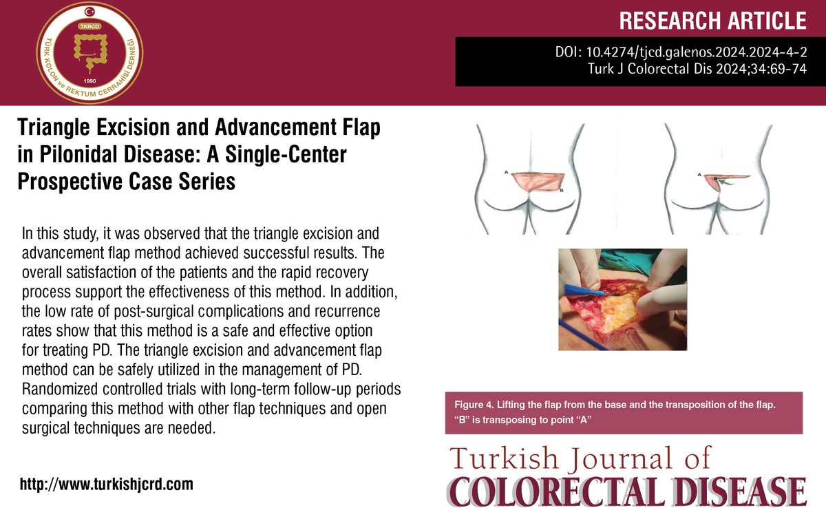 turkdiscolrect's tweet image. Triangle Excision and Advancement Flap in Pilonidal Disease: A Single-Center Prospective Case Series
You can see the free full text of the research by Nurhilal Kızıltoprak et al.
Link : turkishjcrd.com/pdf/b0c0ce94-e…
#Advancement #flap #pilonidal #disease #triangle #excision