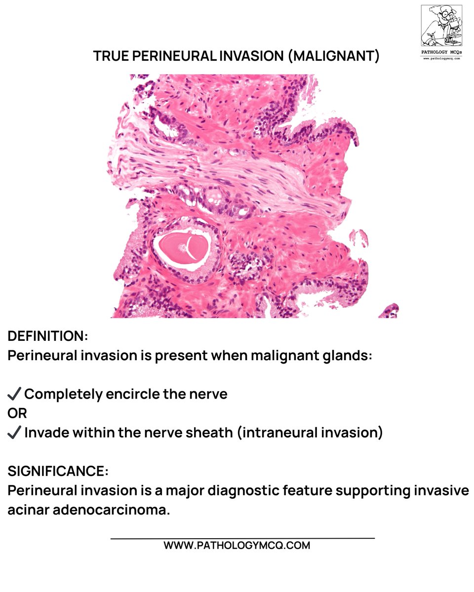 Pathology_mcqs's tweet photo. 🚨 Diagnostic Pitfall: Benign glands can mimic perineural invasion.
🔬 Close gland–nerve proximity ≠ malignancy.
🧠 True invasion requires circumferential encasement or intraneural spread.

#DiagnosticPitfalls #ProstatePathology #GUPathology #PerineuralInvasion https://t.co/tnmqOEKnNT