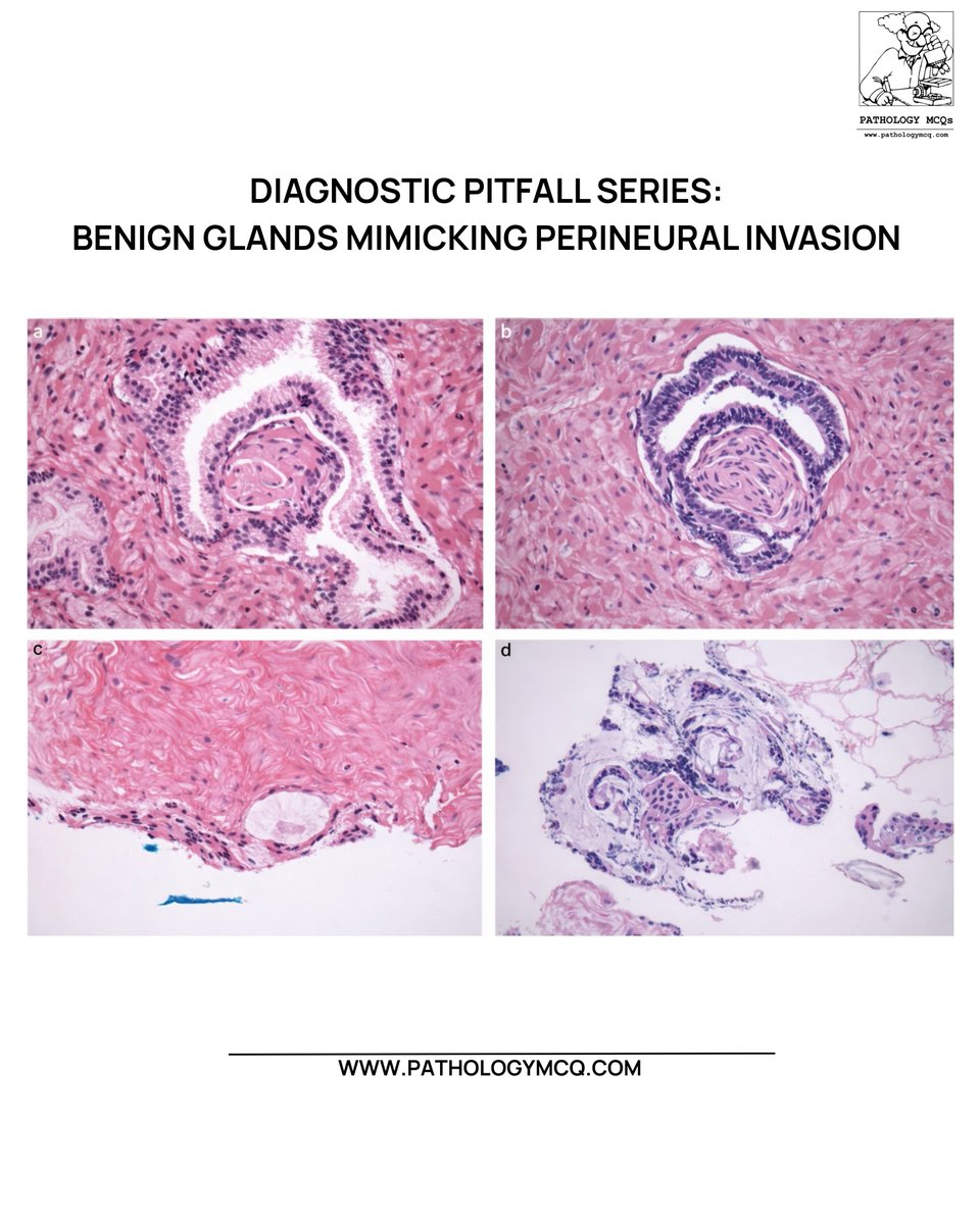Pathology_mcqs's tweet photo. 🚨 Diagnostic Pitfall: Benign glands can mimic perineural invasion.
🔬 Close gland–nerve proximity ≠ malignancy.
🧠 True invasion requires circumferential encasement or intraneural spread.

#DiagnosticPitfalls #ProstatePathology #GUPathology #PerineuralInvasion https://t.co/tnmqOEKnNT