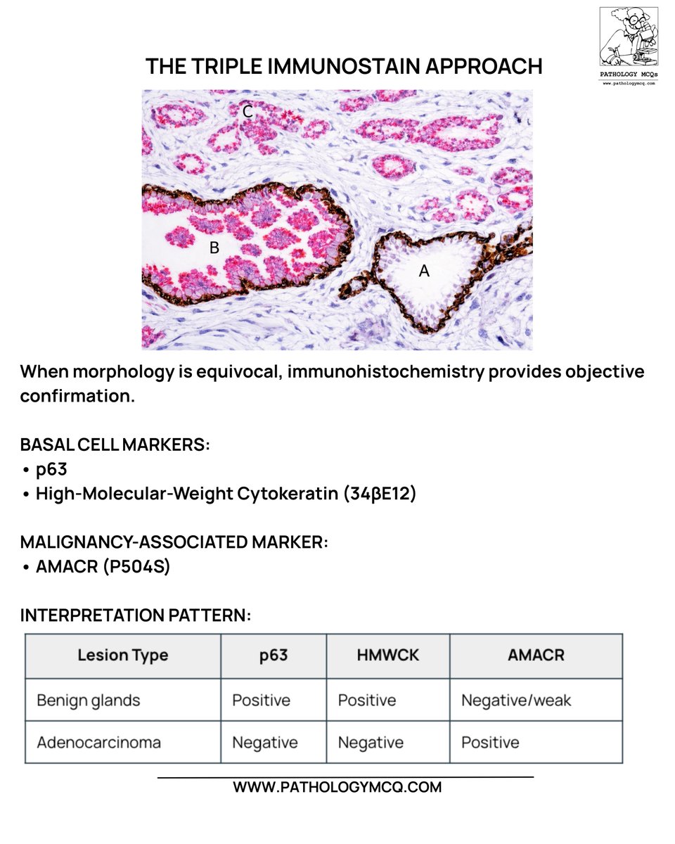 Pathology_mcqs's tweet photo. 🚨 Diagnostic Pitfall: Benign glands can mimic perineural invasion.
🔬 Close gland–nerve proximity ≠ malignancy.
🧠 True invasion requires circumferential encasement or intraneural spread.

#DiagnosticPitfalls #ProstatePathology #GUPathology #PerineuralInvasion https://t.co/tnmqOEKnNT