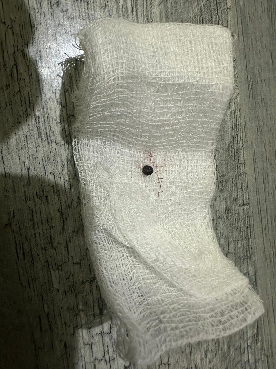 🔔🔔
In the line of duty while covering a protest in #Islamabad after attack on #Iran and killing of Iranian supreme leader #Khamenei. Alhamdulillah metal Pellet removed through a minor surgery 😌 kindly remember me in your prayers 😇 Thank you <a href="/shahbazzahid/">Shahbaz Zahid</a> for being in the