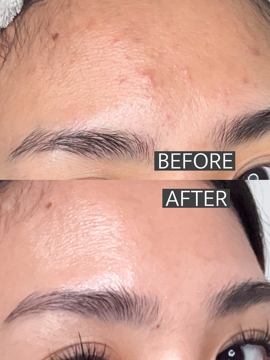 jerawat terhempas pake moisturizer ini?! legit surprised 👏🏻