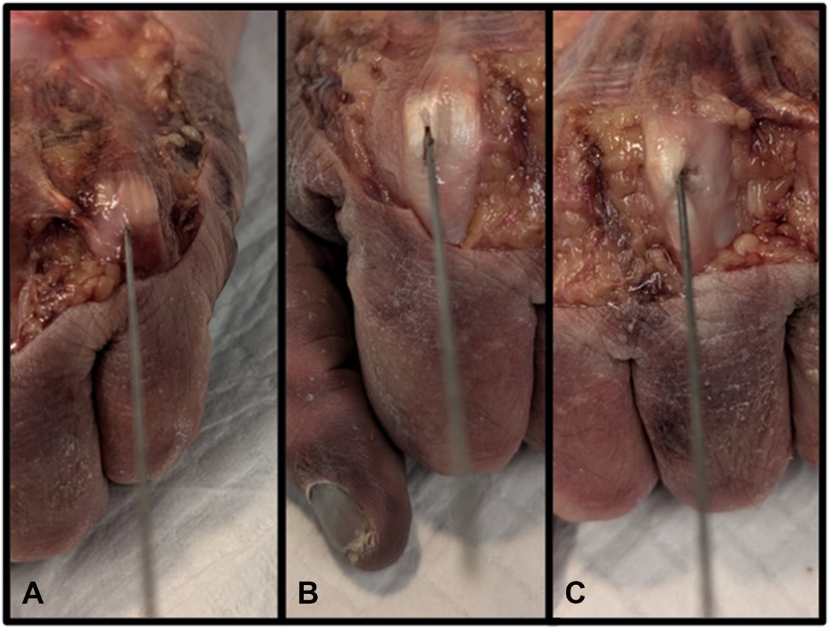 J Hand Surg Am- ASSH tweet media