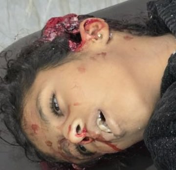 Palestinedaily1's tweet photo. This is what Israel did to the head of one child two hours ago in Gaza.
Anyone cares about children? About girls? About human lives? https://t.co/1mGKre0aUY
