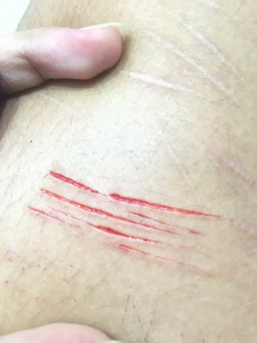 bloodlvct's tweet photo. thigh cuts after sooo long cuz i had no space on wrists.. small sesh on wrists too!! https://t.co/vClYeQgjVI