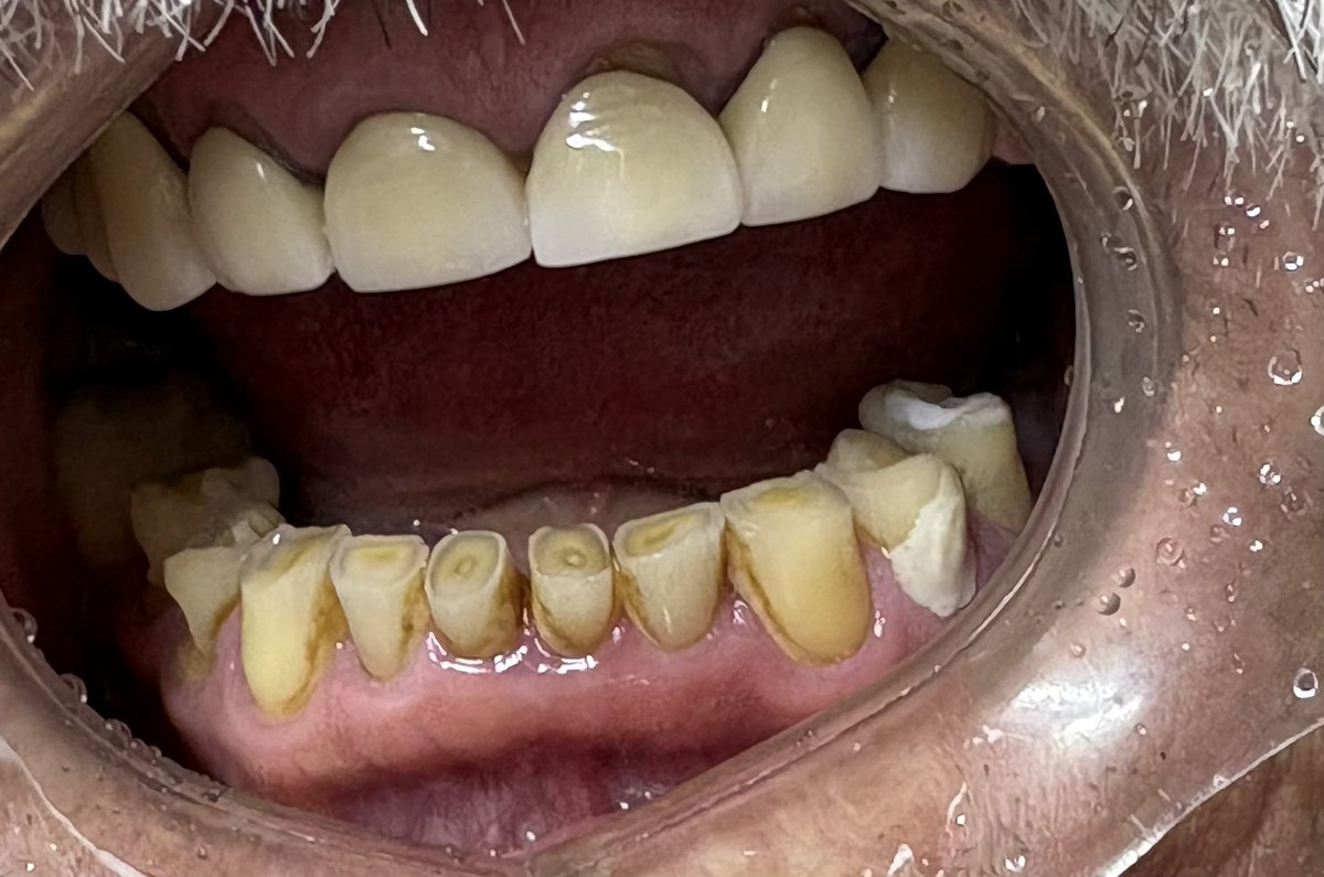 CaRaCony's tweet photo. @En_laDelValle Tienes molestias al masticar ? Te duele la cara y tus dientes están chiquitos? Lo que puedes padecer es Bruxismo! Padecimiento asociado al estrés y ansiedad ! atiéndete no lo pospongas ! Agenda cita en Doctoralia                       https://t.co/P9KsT4Ulhh https://t.co/yf7lNfQkQd