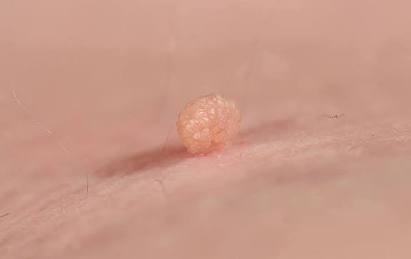 bakhsh_reda's tweet photo. الزوائد الجلدية (Skin tags) مرتبطة بمقاومة الإنسولين .. 

وجود ٥ زوائد او اكثر في الرقبة او الإبطين دليل قوي على وجود مقاومة الإنسولين .. حلل سكر تراكمي .. https://t.co/awpKtB7MfG