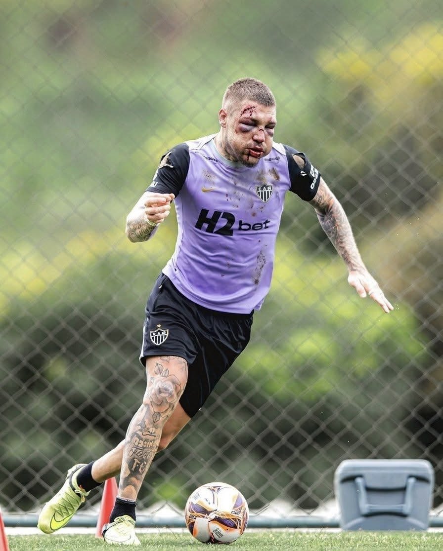 🚨‼️WTF! This is how Lyanco returned to training this morning after yesterday’s brawl in the Campeonato Mineiro final. 😳😳😳