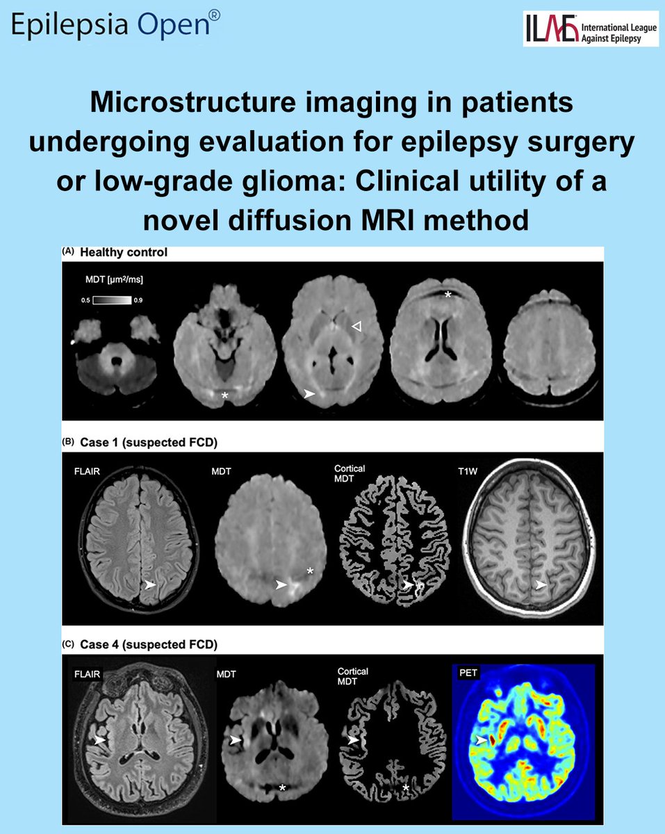 EpilepsiaOpen's tweet photo. MDT MRI is a novel diffusion imaging technique developed to improve imaging of the cerebral cortex.
https://t.co/NlWXlkN4J4
#epilepsy #ilae #epilepsiaopen #diffusionweightedimaging #DTI #focalcorticadysplasia #meandiffusivity https://t.co/WgF9vgjrP1