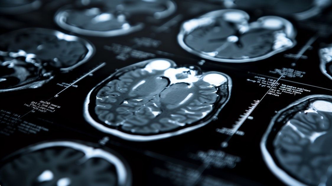 AuntMinnie's tweet image. Unstable brain networks may drive multiple sclerosis fatigue #radiology #multiplesclerosis #MRI @MedUniGraz buff.ly/iLh8WXE