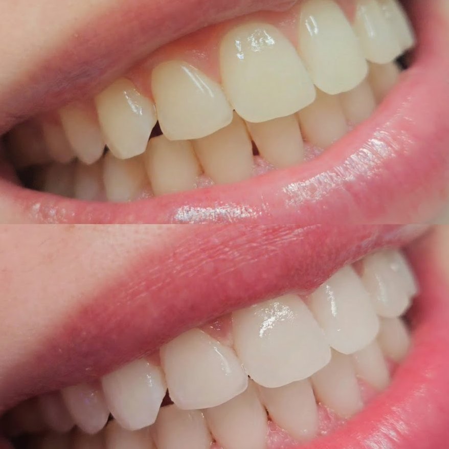 LopeDavis75327's tweet image. Caring for Dental Health #Dentist #TeethWhitening