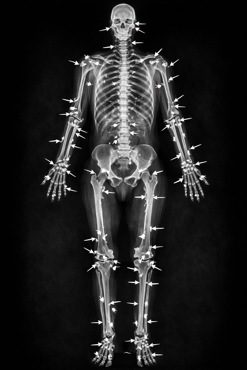 Microinteracti1's tweet photo. X-ray of Barron Trump’s bone spurs right now. 

Stay connected,
Follow Gandalv @Microinteracti1 https://t.co/BRoWyEbjJd