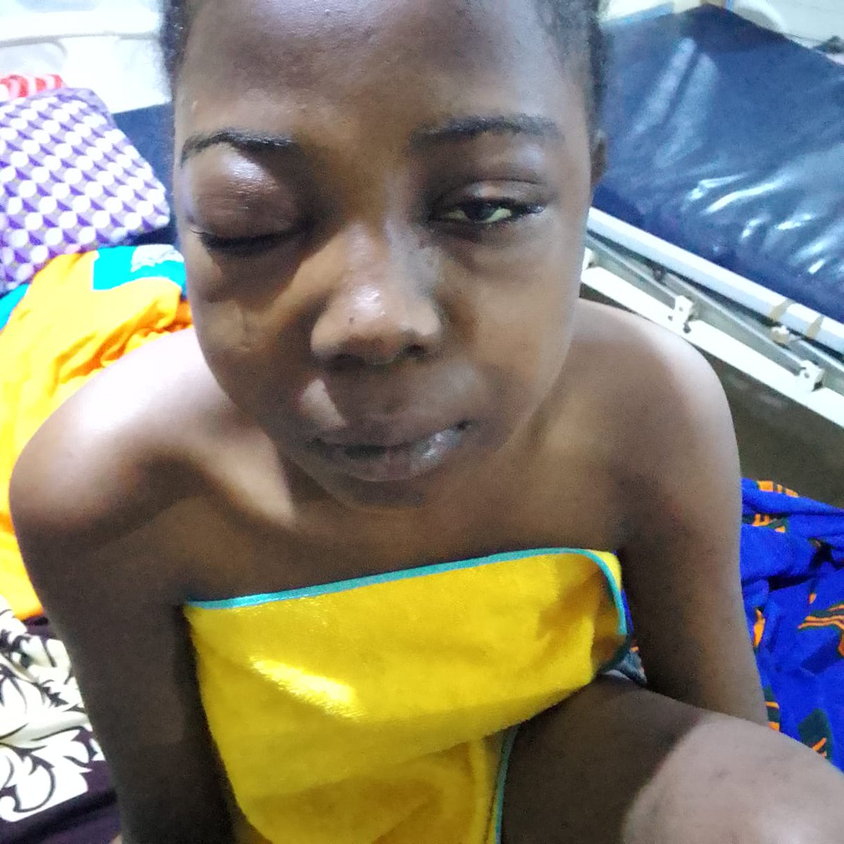 EstherEhoc62403's tweet photo. I am a 19 yr sickle cell patient currently on admission for Sickle cell crisis with eye complications. 

I have been told I need blood and antibiotics and other medications for my treatment. 

My younger sibling who is also a sickle cell patient is on admission as well. https://t.co/Vu19Gt6od8
