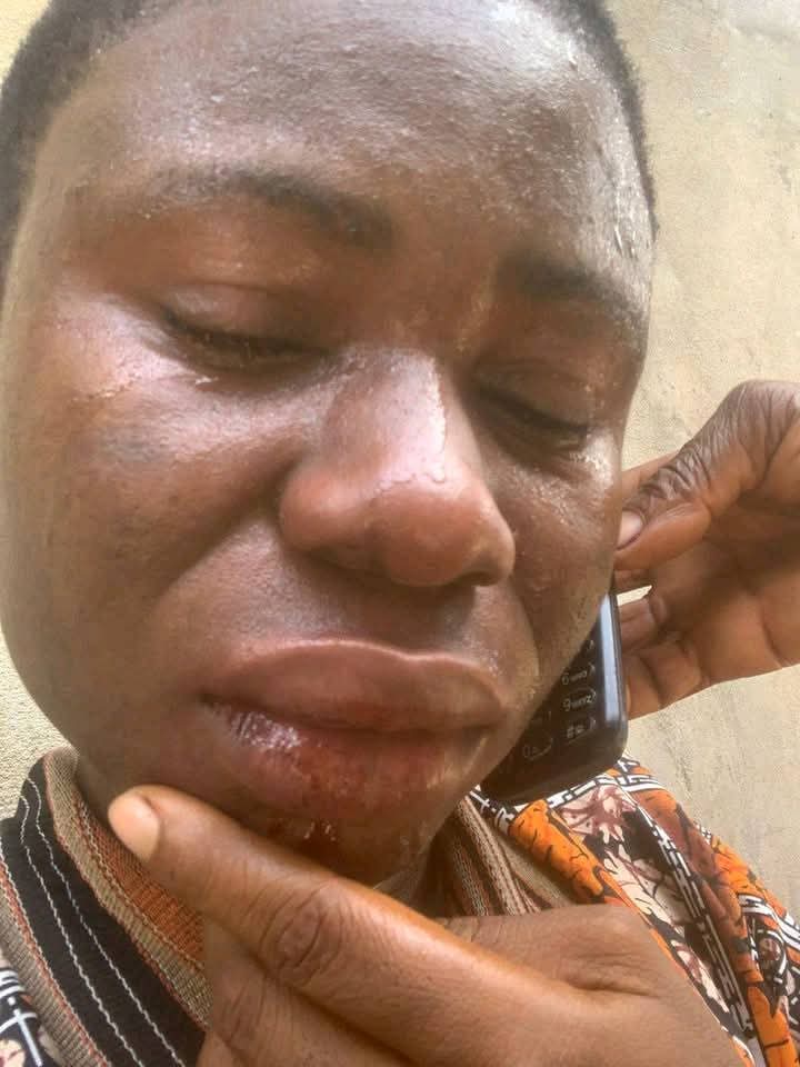 VoiceOfMasses10's tweet photo. Miss Ogadinma Minnie Uchechi was alleged to have been assaulted by the Chairman of Ahoada West Local Government Area, Eugene Cheta Epelle..

According to Miss Ogadinma, her offence was making a Facebook post highlighting the deteriorating and unsafe learning environment at Community Secondary School, Odiokwu, Ahoada West LGA. In the post, she reportedly appealed to well-meaning individuals and organizations to assist in renovating the school. She stated that both she and the Chairman hail from the same community.
She alleged that upon seeing the post, the Chairman became offended, accusing her of embarrassing him publicly. She further claimed that the Chairman later visited her family residence, where he met her mother and expressed displeasure over the post, accusing her of attempting to tarnish his image online.
Miss Ogadinma alleged that while her mother was appealing to the Chairman for forgiveness, he noticed her presence and allegedly instructed his younger brother to physically assault her. She claimed that she was beaten and struck with a shovel during the incident. Photographs circulating online are said to show injuries allegedly sustained from the attack.