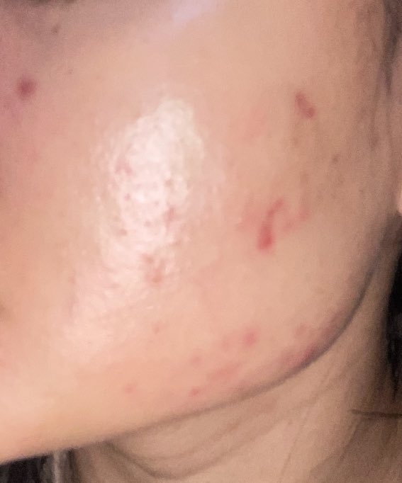 cryindec's tweet photo. pernah di tahap jerawat gini, trial and error coba-coba produk. basic skincare is a key!! krn mau pake obat apapun kl basicnya blm oke bakalan susah

masih ada jerawat satu dua sih karena emg skintype aku oily acne prone skin, udah acceptance hehe https://t.co/SpTci2T9ZL