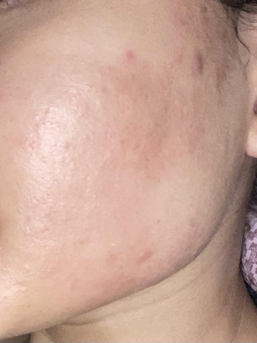 cryindec's tweet photo. pernah di tahap jerawat gini, trial and error coba-coba produk. basic skincare is a key!! krn mau pake obat apapun kl basicnya blm oke bakalan susah

masih ada jerawat satu dua sih karena emg skintype aku oily acne prone skin, udah acceptance hehe https://t.co/SpTci2T9ZL