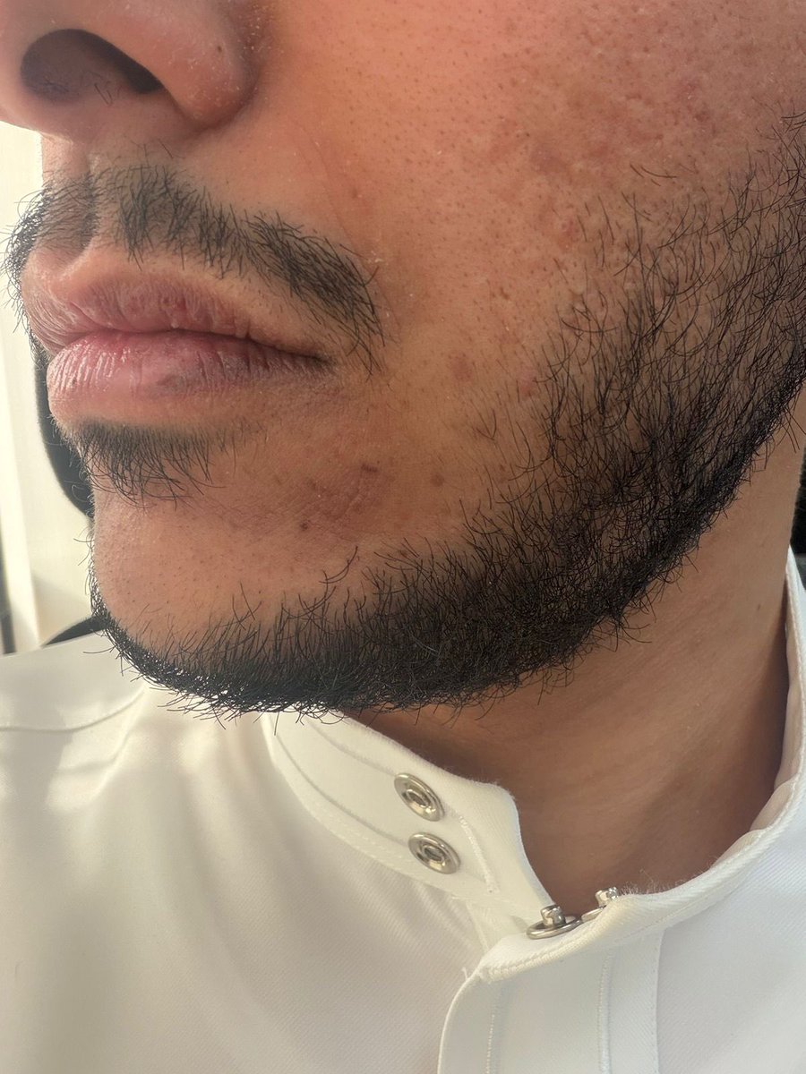 _1Nix7's tweet photo. @DrAhmedAlissa دكتور رد علي ارجوك 
عندي اخوي من الصم والبكم يبي حل مثل ماهو موضح بالصوره حط فازلين ولا فاد https://t.co/zlb2bZvwxQ