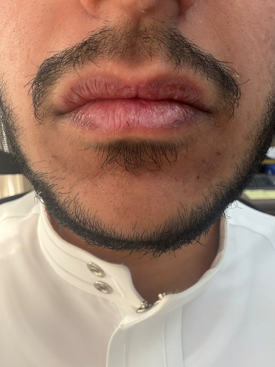 _1Nix7's tweet photo. @DrAhmedAlissa دكتور رد علي ارجوك 
عندي اخوي من الصم والبكم يبي حل مثل ماهو موضح بالصوره حط فازلين ولا فاد https://t.co/zlb2bZvwxQ