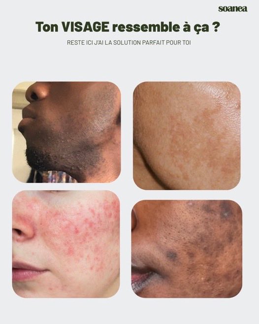 iamtantine's tweet photo. Si après ton acné tu as des taches sur ton visage qui ne disparaissent pas. 

Je te recommande ce sérum

Le sérum Aclarea combine azeloglicina, acide tranexamique, niacinamide et extrait de réglisse pour apaiser, éclaircir et uniformiser le teint.

Lien: https://t.co/kTHJ6uykVx https://t.co/huRKWtDEdX