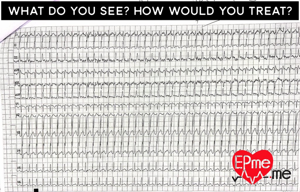 EPmedotme's tweet photo. What’s going on in the ECG? How would you treat?  (Adenosine test in comments) let me know what you think before &amp; after adenosine.
#ecg #electrophysiology #cardiology #epeeps #arrhythmia https://t.co/WMzBqvL7tx