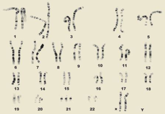 forallcurious's tweet photo. 🚨: Japanese scientists have achieved something that only a few years ago seemed like science fiction: removing the extra copy of chromosome 21 — the genetic cause of Down syndrome — in lab-grown human cells. https://t.co/jksdo2CqYZ