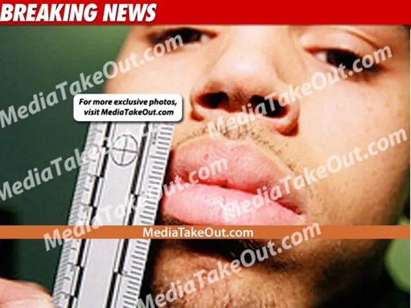 “chris brown had injuries from rihanna that night.”

the injuries in question: