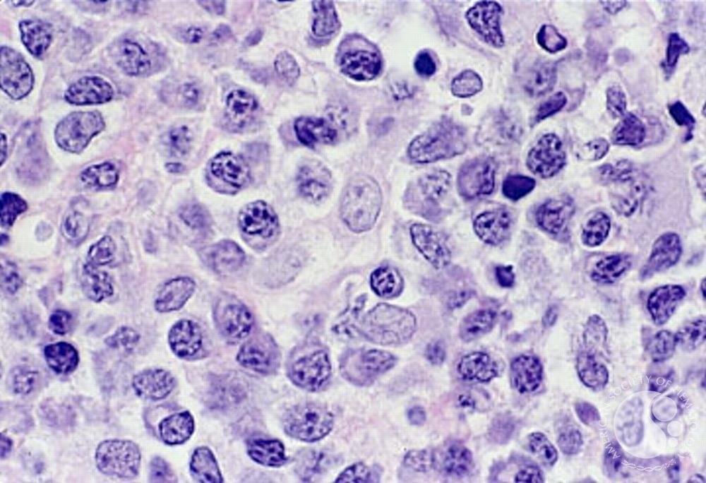 sanamloghavi's tweet image. Monoclonal kappa light chain staining of plasma cells🔬 indicates a plasma cell proliferation, as seen here.  Image: Marshall Kadin/ASH Image Bank. #MedEd #Hematology #ASHImageBank #hemepath imagebank.hematology.org/image/2029