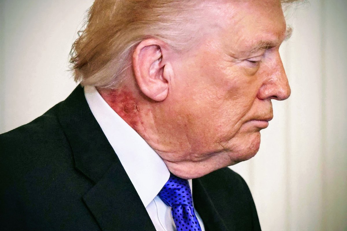 faizannriaz's tweet photo. Trump has a significant rash-like injury on his neck today. https://t.co/Mfmu3998ze