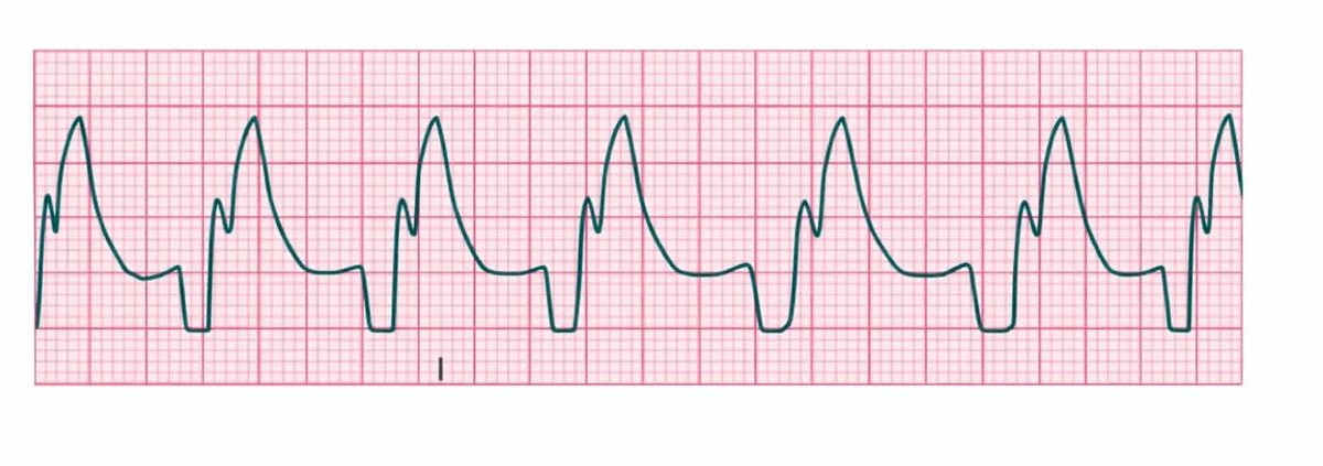 albertoortegana's tweet photo. What is the Rhythm Interpretation????
=> Test your Knowledge.
@dr_manish_ydv @Dr_Shiv_kumar_ @DrAkhilX @DrMedica_13 @drobiy12 @hemo_shk https://t.co/pKa6plcmh1