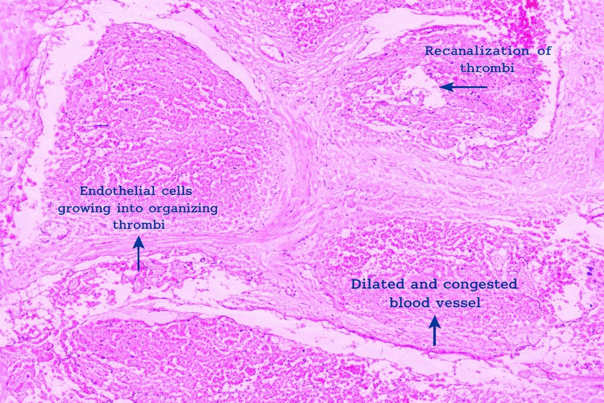 thejourneymate's tweet photo. Histologic analysis shows that the thrombus composition is very heterogeneous between patients. The distribution of each component often differs between those with cardiac thrombi and with arterial thrombi, and the efficacy of thrombectomy

#cardiacpath https://t.co/jLewVWeR5h