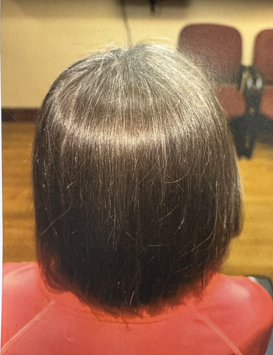 ToyosHair's tweet photo. Ever notice that the back of your head has the thickest hair? These follicles are DHT resistant: not affected by age, stress or genetics. 

And when we move, they stay that way. https://t.co/P3cXqkLxyD