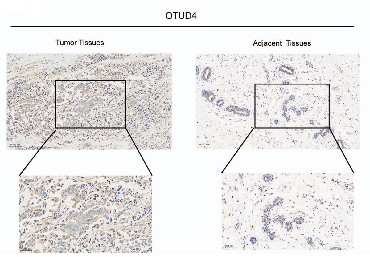 MammaryCell's tweet photo. The role of oncogene OTUD4 in #TNBC.

Researchers provide findings suggesting OTUD4 expression correlates with poor prognosis and overexpression in TNBC. 

📝 https://t.co/fyNPEuoQPt https://t.co/FgzkUcYNE6