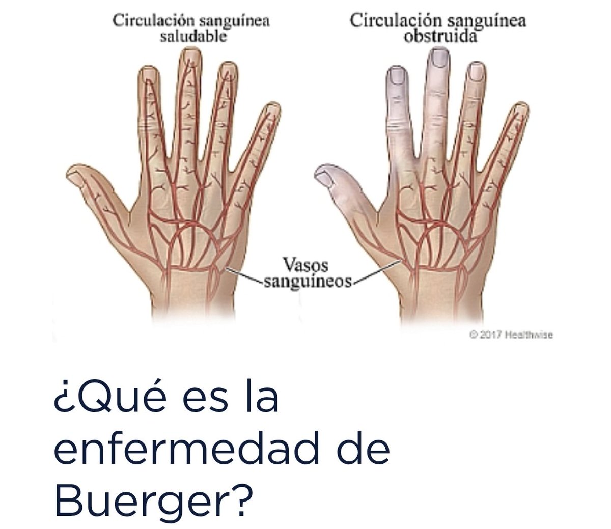 RCPdesdemicole's tweet photo. Estudiamos en la carrera algo que ya daba bastante impresión en los libros; pero cuya realidad acaba superando horriblemente a la ficción.

Uno de los síndromes más brutales ligado al consumo de tabaco: la tromboangeítis obliterante.

También llamada "síndrome de Buerger". https://t.co/xXhZJM6g8c