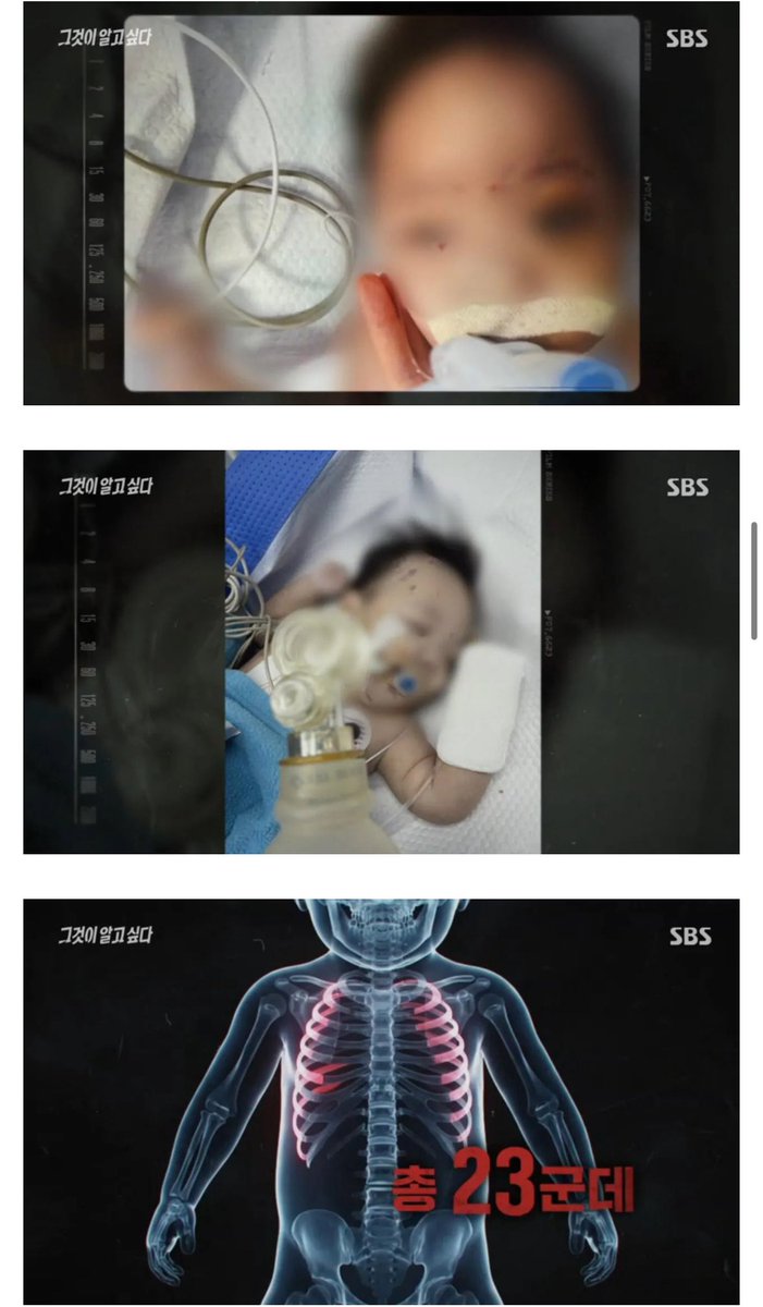 min1546574's tweet photo. 진짜 화남주의🤬) 
최근 그알에 나온 영아 학대사건 

피해자인 아기는 생후 133일  ‘다발성 외상에 의한 출혈성 쇼크 및 다발성 장기부전'으로 사망.

참고로 돌봄이 아니라 ‘친부모’임 https://t.co/aA9O1OPU6d