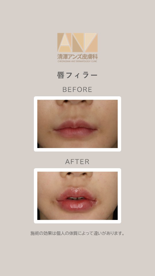 anzclinic's tweet photo. シルエットフィラーで自然にボリュームUP💋✨
顔のバランスに合わせて“必要な分だけ”注入し、ふっくら美しいリップラインへ。
1対1予約制で丁寧に施術します😌
ご予約・お問い合わせはLINEから💌

#唇フィラー #ヒアルロン酸 #ぷっくり唇 #韓国美容 https://t.co/SAPqfpgIOX