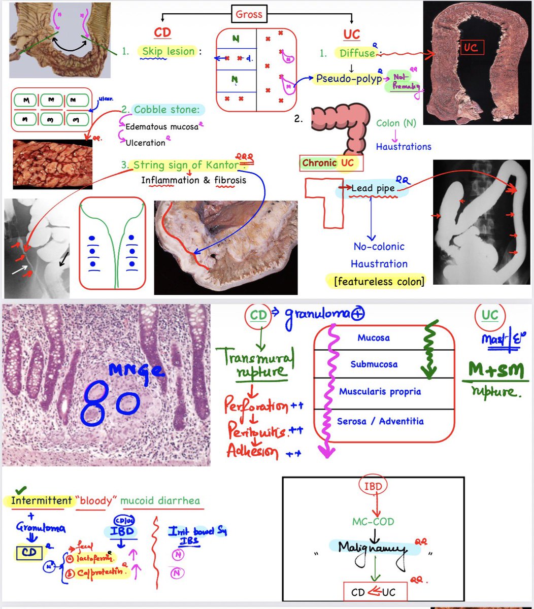 drdev555's tweet photo. 🕉 "Crohns disease" vs "Ulcerative colitis":
➖➖➖➖➖➖➖➖➖➖➖➖
👉Lecture snapshot from “Integrated Concepts of Pathology” By Dr. Devesh Mishra 👍
👉Build Concepts.
👉Strengthen Clinical Thinking.
👉Succeed with Clarity.
#drdeveshmishra #dpma #neetpg #fmge #inicet https://t.co/Uoy9Sv855v
