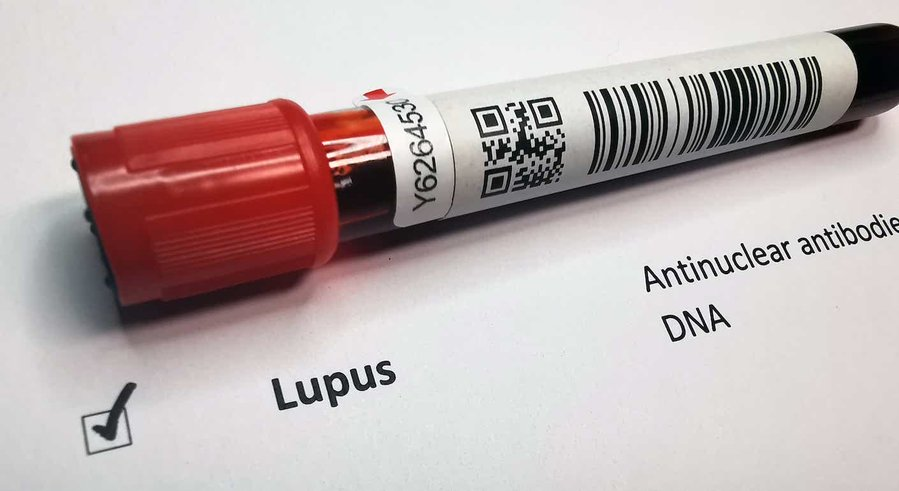 jyves94's tweet photo. Une nouvelle #CAR_Tcell 🧬 pourrait radicalement changer l'avenir des maladies auto-immunes

Un essai clinique étudie actuellement si un nouveau traitement pourrait aider les patients atteints de maladies auto-immunes non contrôlées

#Allogene #allogénique
https://t.co/jLdJqGCHc1 https://t.co/Atfg5zo9BB