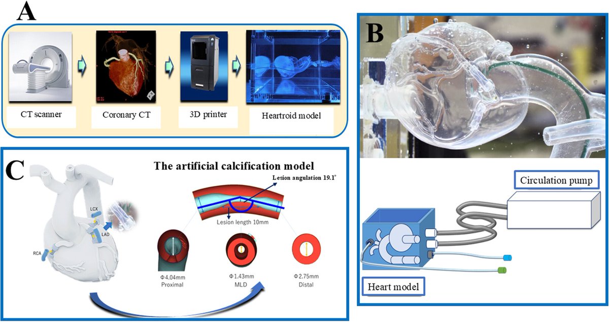 gbiondizoccai's tweet photo. Guidewire type and rotational speed significantly influence directional control during rotablation. High-speed ablation with an extra-support wire minimizes directional discrepancy and allows more predictable and controlled ablation https://t.co/vou9UCc9hi @ccijournal https://t.co/N4kT1VPMtg