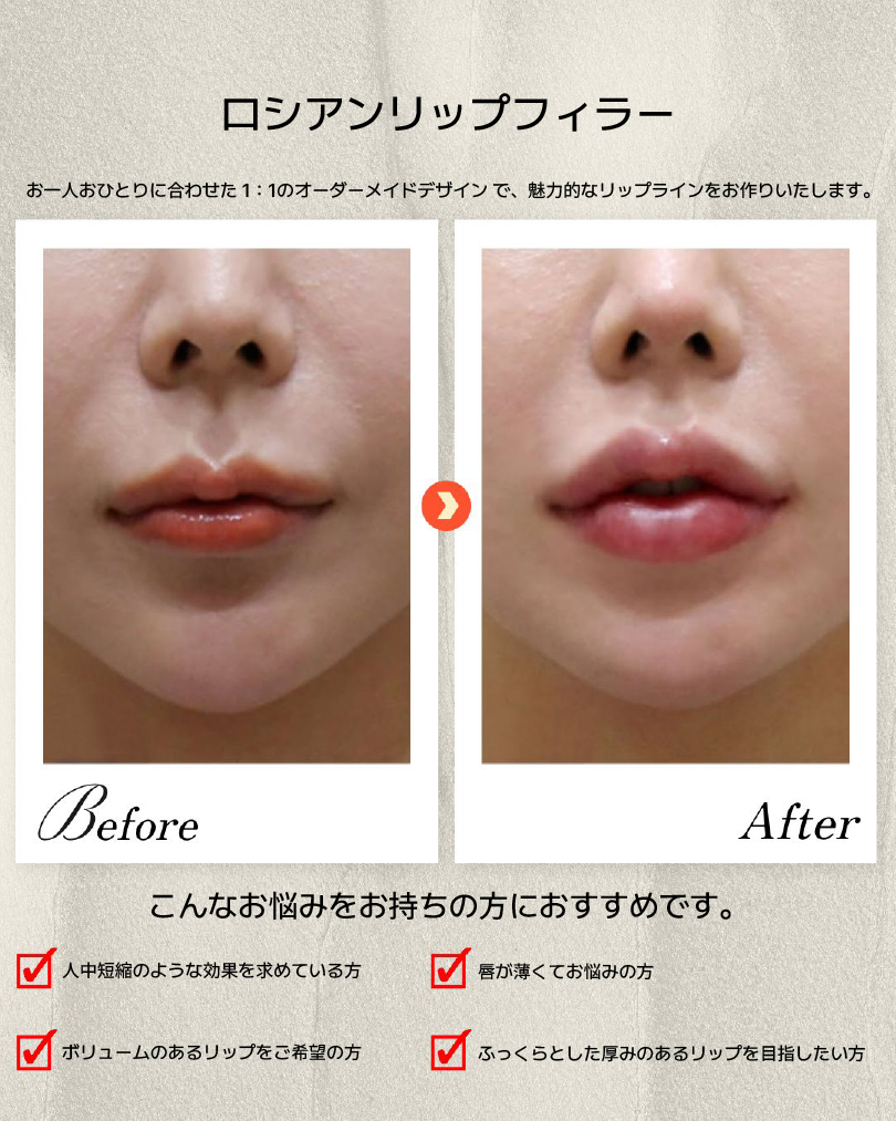 dashon_jpn's tweet photo. 💋ロシアンリップフィラー

縦にボリュームを出して、
人中短縮効果＋立体感のある唇へ。
✔ 唇が薄い
✔ 人中を短く見せたい
✔ ぷっくり上品なボリュームが欲しい

一人ひとりに合わせた1:1デザインで自然に仕上げます✨
ご予約・ご相談はLINEへ📩 https://t.co/oX3ZVi2Q5l