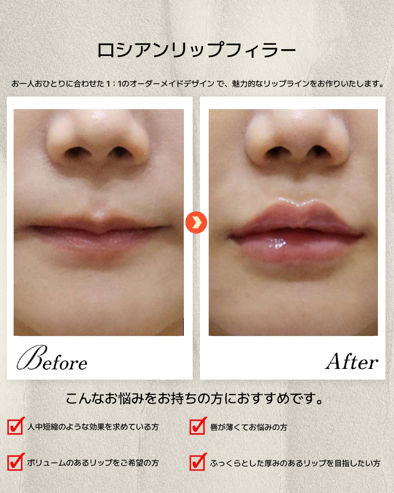 dashon_jpn's tweet photo. 💋ロシアンリップフィラー

縦にボリュームを出して、
人中短縮効果＋立体感のある唇へ。
✔ 唇が薄い
✔ 人中を短く見せたい
✔ ぷっくり上品なボリュームが欲しい

一人ひとりに合わせた1:1デザインで自然に仕上げます✨
ご予約・ご相談はLINEへ📩 https://t.co/oX3ZVi2Q5l