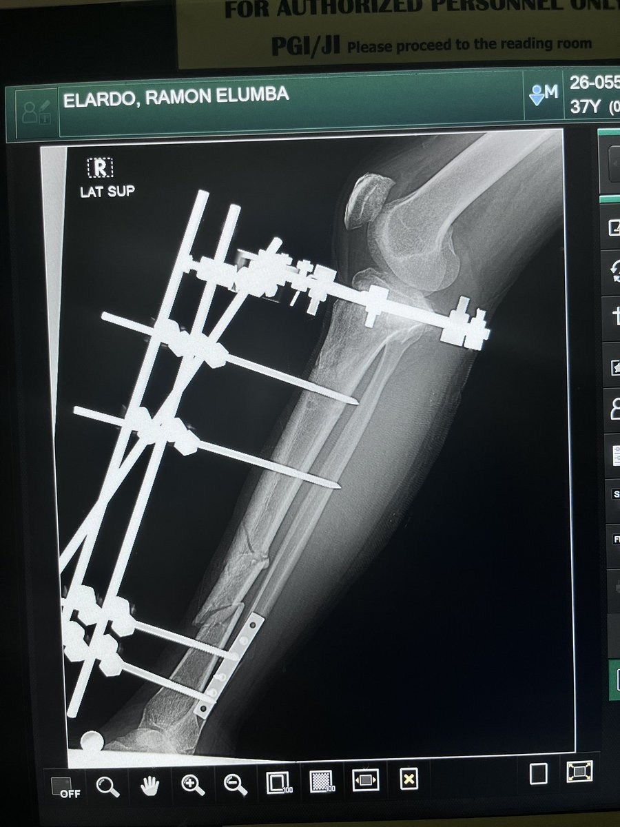 Monchoo_Elardo's tweet photo. Life changed in a single moment. 70 days after my accident, slowly healing but still forever grateful! https://t.co/CeWwPy1g6L
