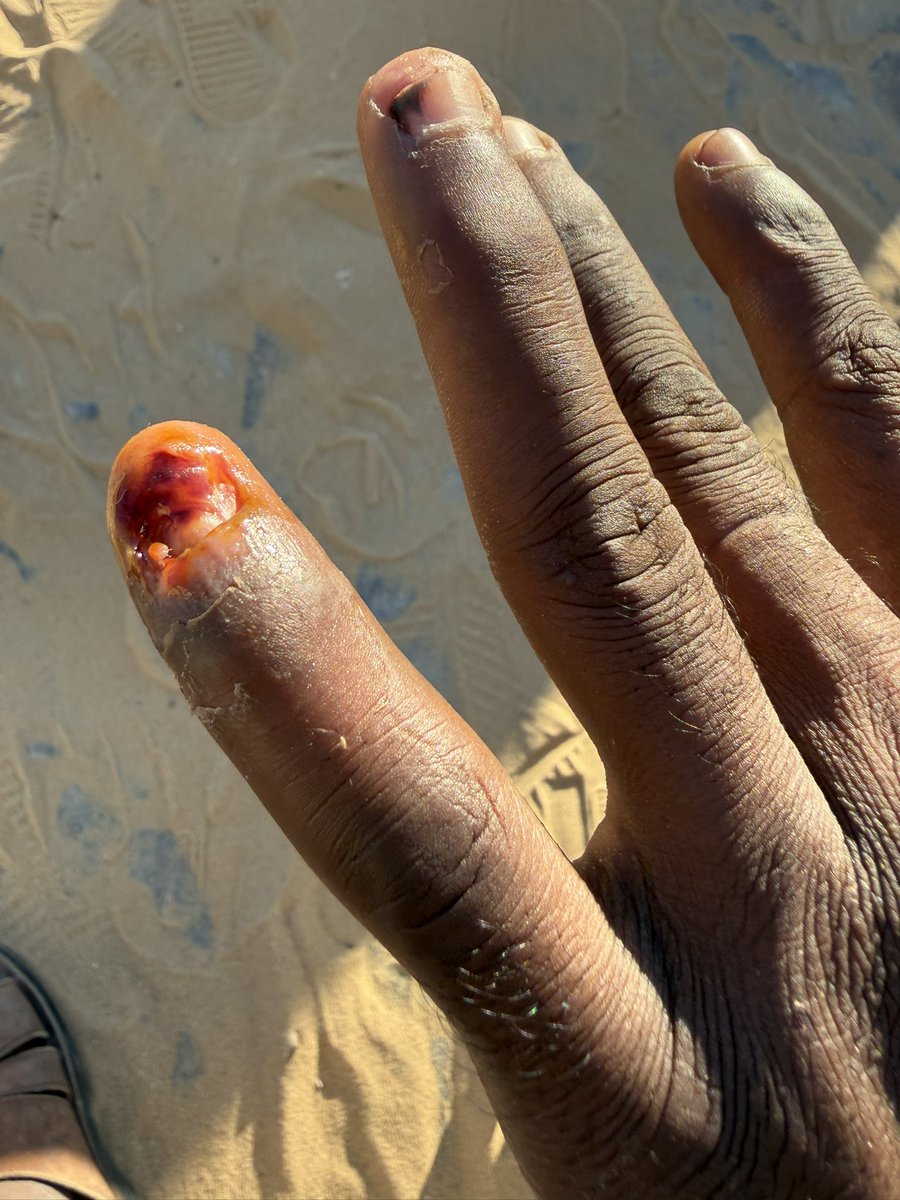 I WILL DIE😭 

Unfortunately, my poor little my daughter  body is full of pimples and I can't do anything for her. She urgently needs your help to provide tr

3 replies — even dots — can break the
 algorithm😭

chuffed.org/project/135556