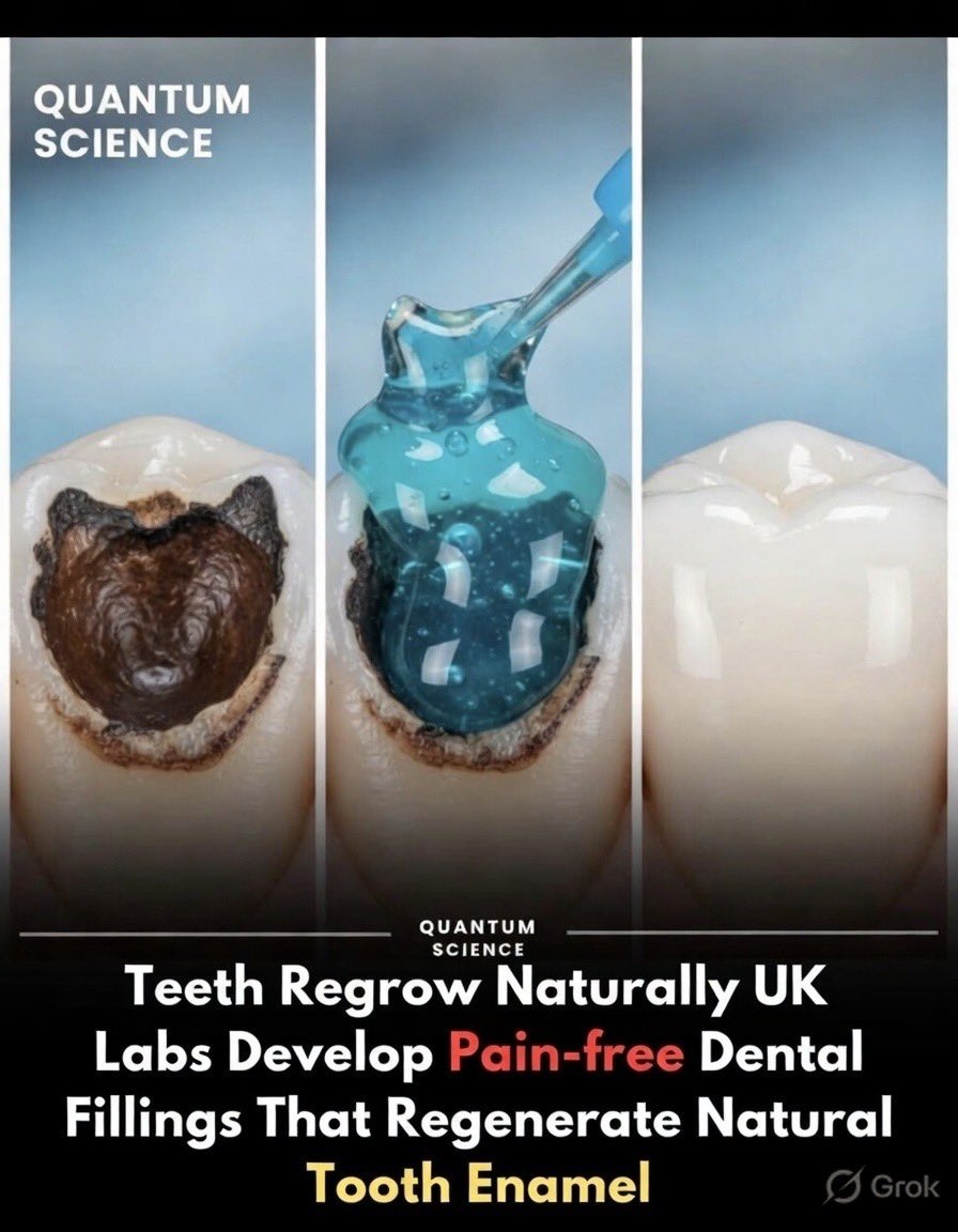 argosaki's tweet photo. “Drill No More: Revolutionary Gel Lets Teeth Regrow Their Own Enamel Pain-Free!”

The core claim of a pain-free dental filling that regenerates natural tooth enamel is based on real scientific advancements. 

The most recent breakthrough, published in November 2025 in Nature Communications, comes from researchers at the University of Nottingham in the UK, in collaboration with international teams. 

They developed a protein-based gel that mimics natural enamel formation in infants, acting as a scaffold to draw calcium and phosphate from saliva for epitaxial mineralization, effectively repairing and regrowing enamel. 

This could lead to pain-free treatments without drilling, reducing sensitivity and preventing further decay. 

Earlier related research from the University of Washington (US) in 2020 involved similar peptide-based remineralization, but the 2025 gel is the latest milestone. 

https://t.co/ZRdgnYTTqA

Social media claims (e.g., on Facebook, Instagram, LinkedIn) often misattribute or blend these, claiming US origins, but credible sources confirm the UK-led development. 

It’s still in early testing phases, with potential for clinical use soon, but not yet widely available. 

https://t.co/aQqIAblwta

Researchers have unveiled a cutting-edge gel that stimulates the natural regrowth of tooth enamel, paving the way for painless dental repairs that surpass conventional fillings.

Tooth decay affects billions, often requiring invasive procedures. 

This bioinspired solution eliminates drilling by harnessing the body’s minerals to rebuild enamel, offering a durable, natural restoration that could prevent future cavities and sensitivity.

Important Details: 
• Protein-based gel mimics infant enamel development 
• Attracts calcium and phosphate from saliva for regeneration
 • Applied directly to damaged areas without pain or anesthesia 
• Early tests show enamel-like strength and structure 
• Could benefit global oral health by reducing repeat treatments 
• Marks a paradigm shift in preventive and restorative dentistry
This innovation promises to redefine smiles worldwide.
#DentalInnovation #EnamelRegrowth #PainFreeFillings #RegenerativeMedicine #ScienceBreakthrough #OralHealth
Video 👇👇
Dive into the science of this enamel-regenerating gel with this informative video from the University of Nottingham’s breakthrough: 
https://t.co/QXxI0IaUdU. 
It explains how the gel works to repair teeth naturally and its potential impact on dentistry.