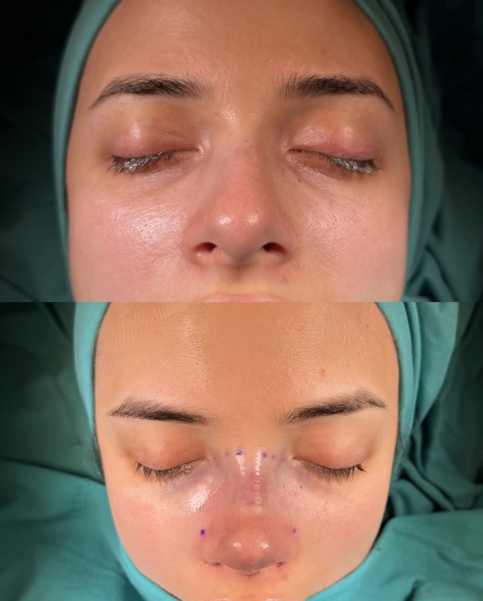 alevcamcioglu's tweet photo. Female Nose Job Before After Istanbul, Turkey 

 Contact us to get information about rhinoplasty.  

Webpage: https://t.co/x91oeZ4ECk  

Prices and Packages: https://t.co/BWZE5UWvn6  

Before & After Photos: https://t.co/ubAkZGWZZ9  

+(90)532 477 64 96 🇹🇷
 +(90)535 206 10 95 🇬🇧🇩🇪  

Our clinic is a recognized International Health Tourism Center by the Turkish Ministry of Health. Under the terms of this authorization and with the patient’s consent, the patient’s picture is used.  All our posts are for informational purposes .

  #rhinoplasty #rhinoplastyresults #rhinoplastyturkey #rhinoplastyspecialist #rhinoplastybeforeandafter #rhinoplastyistanbul