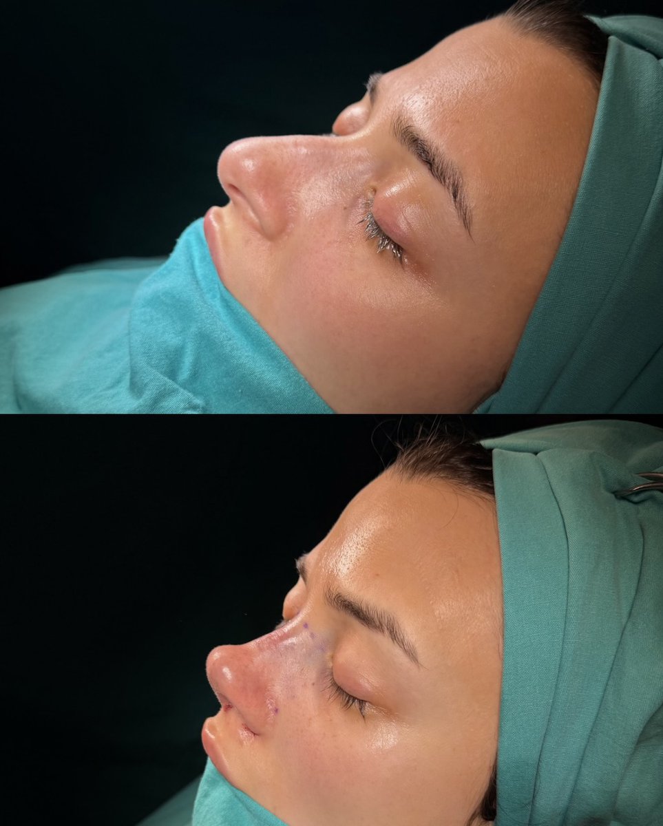alevcamcioglu's tweet photo. Female Nose Job Before After Istanbul, Turkey 

 Contact us to get information about rhinoplasty.  

Webpage: https://t.co/x91oeZ4ECk  

Prices and Packages: https://t.co/BWZE5UWvn6  

Before & After Photos: https://t.co/ubAkZGWZZ9  

+(90)532 477 64 96 🇹🇷
 +(90)535 206 10 95 🇬🇧🇩🇪  

Our clinic is a recognized International Health Tourism Center by the Turkish Ministry of Health. Under the terms of this authorization and with the patient’s consent, the patient’s picture is used.  All our posts are for informational purposes .

  #rhinoplasty #rhinoplastyresults #rhinoplastyturkey #rhinoplastyspecialist #rhinoplastybeforeandafter #rhinoplastyistanbul